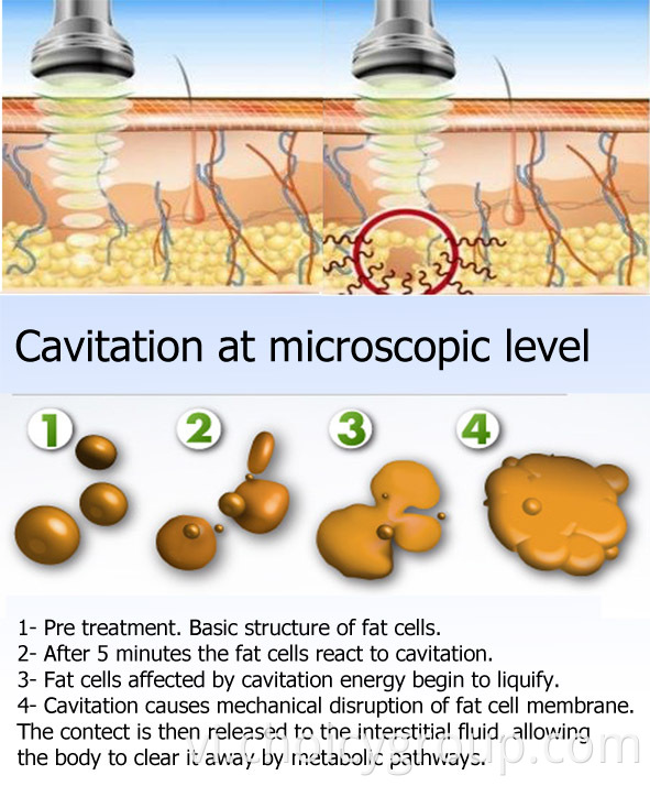 Choicy Cavitation RF Slimming Machine